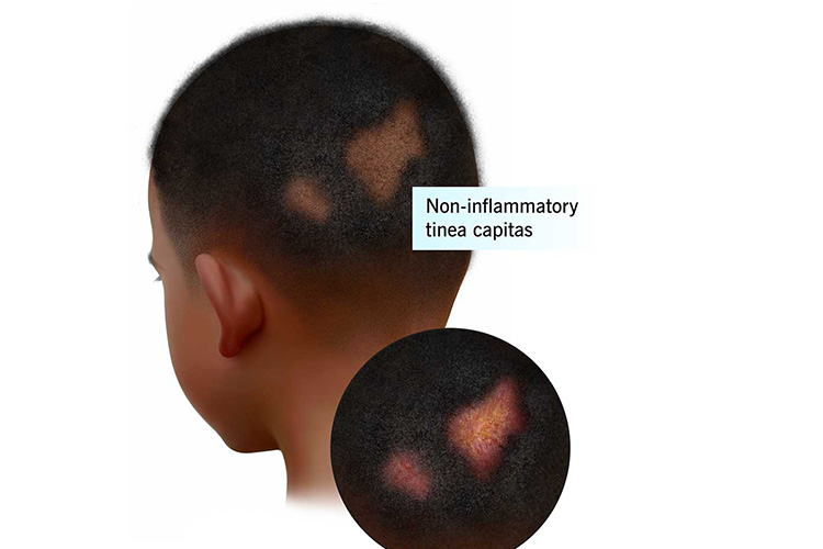 تینه آ کپیتیس در کودکان